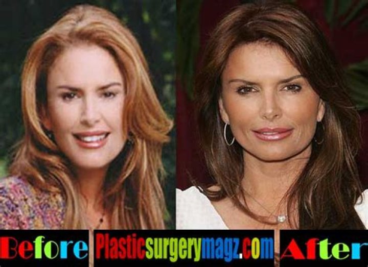 Roma Downey Plastic Surgery Before and After